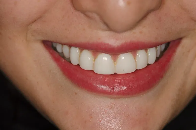 Caso 02, antes: vista frontal do sorriso com os dentes anteriores superiores antes do tratamento
