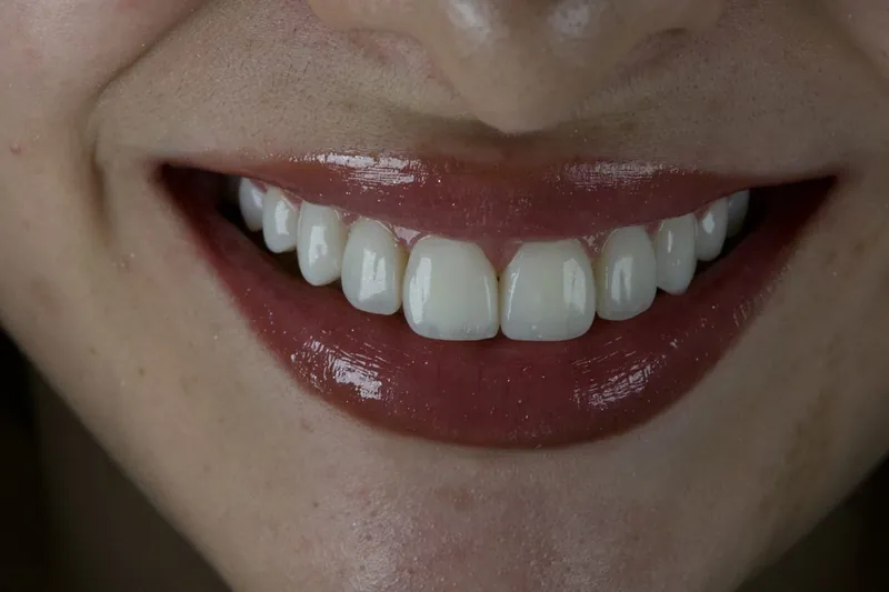 Caso 02, depois: vista frontal aproximada do sorriso, com forma e brilho dos dentes anteriores
