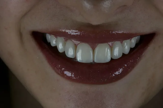 Registro clínico em vista frontal aproximada de um sorriso, com detalhe da forma, da textura e do brilho dos dentes anteriores superiores