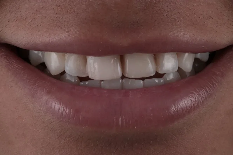 Caso 03, antes: vista frontal aproximada com espaçamento e alterações de forma nos dentes anteriores