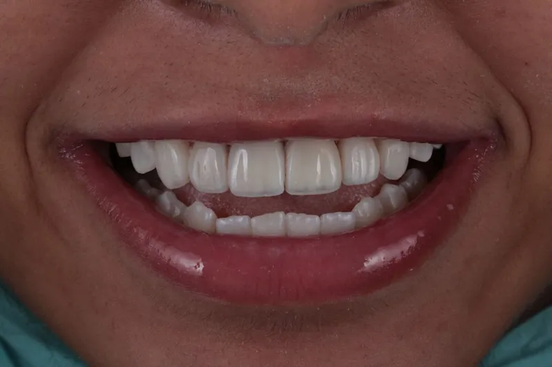 Caso 03, depois: vista frontal do sorriso amplo, com os dentes anteriores em forma e alinhamento harmônicos