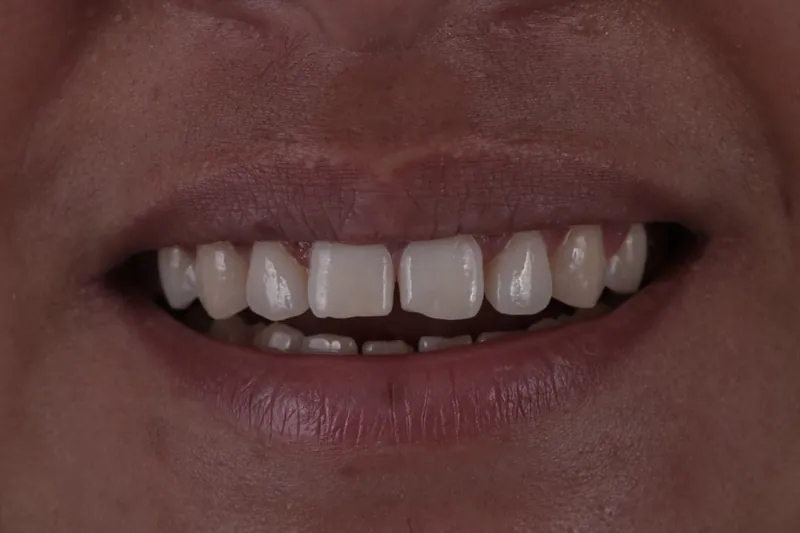Caso 01, antes: vista frontal do sorriso com diferenças de forma e de contorno entre os dentes anteriores
