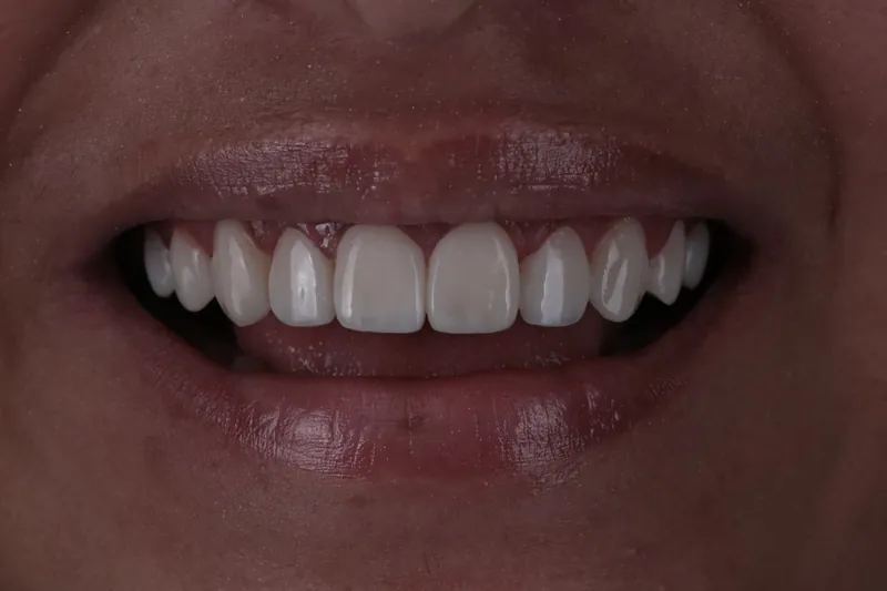 Caso 01, depois: vista frontal do sorriso com os dentes anteriores superiores em nova forma e contorno